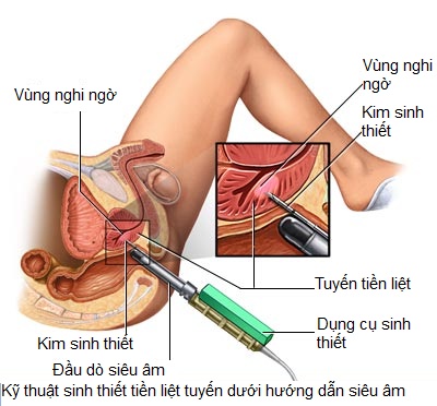 CHẨN ĐOÁN UNG THƯ TIỀN LIỆT TUYẾN