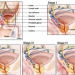 Ung thư tuyến tiền liệt