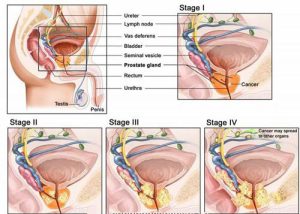 Ung thư tuyến tiền liệt